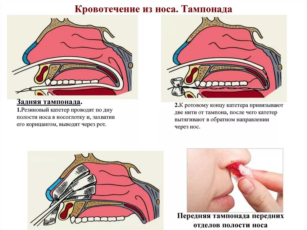 Карта смп носовое кровотечение. Передняя тампонада носа схема. Носовое кровотечение тампонада носа. Носовые кровотечения передняя и задняя тампонады. Задняя тампонада полости носа техника.