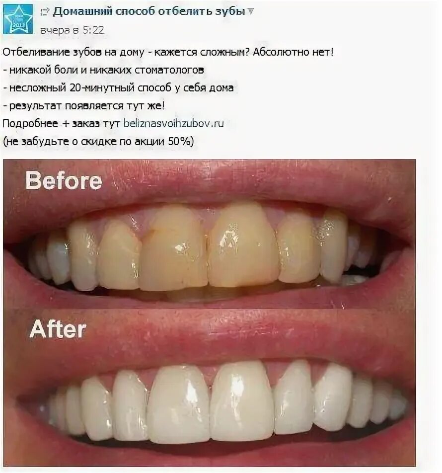 Отбеливание зубов. Отбеливание зубов до и после. Отбеливание зубов содой до и после.