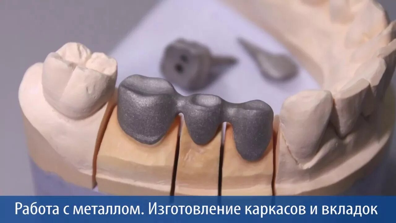 Метод изготовления мостовидных протезов