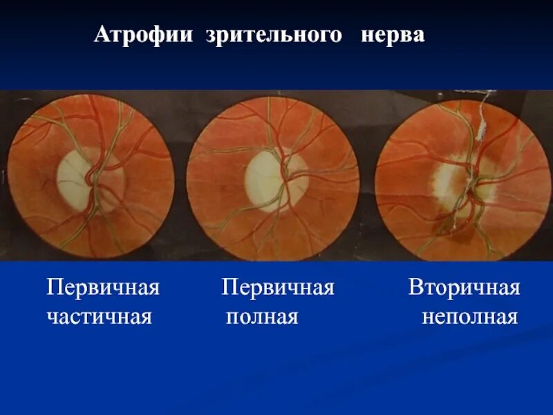 Вторичная постзастойная атрофия зрительного нерва. Нейропатия зрительного нерва Лебера. Атрофия зрительного нерва Лебера патогенез. Частичная атрофия зрительного нерва. Тип зрительного нерва