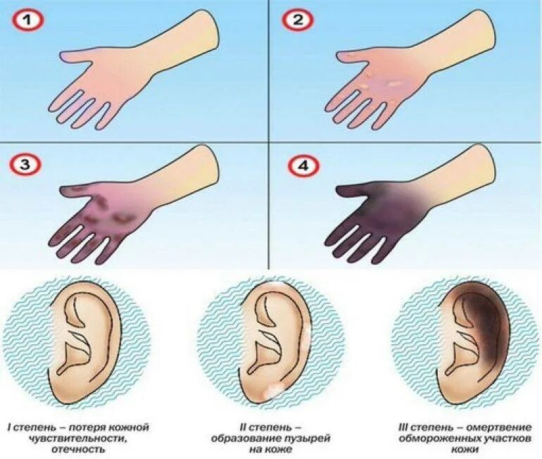 Обморожение 1 степени первая. Отморожение 3 степени симптомы.