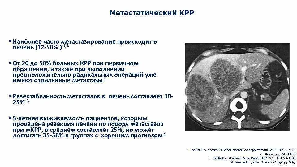 Метастазы в печени 4 стадия сколько живут. Вторичные Метастатические поражения печени. Метастатическое поражение печени. Метастатические опухоли печени.