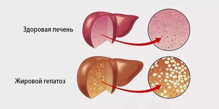 Гепатоз печени что делать. Гепатоз печени что делать