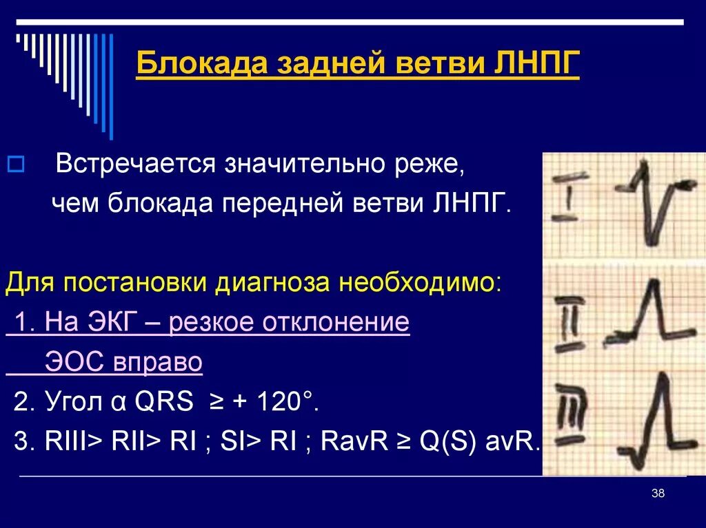 Блокада левой задней ножки. Неполная блокада задней ветви ЛНПГ ЭКГ. Блокада задней ветви левой ножки пучка Гиса. Блокада левой задней ножки пучка Гиса. Признаки блокады задней ветви левой ножки на ЭКГ.