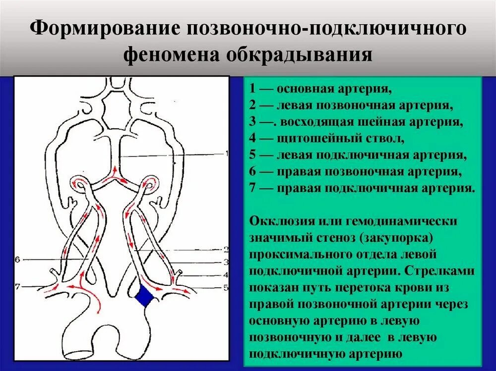 Стеноз проксимального отдела