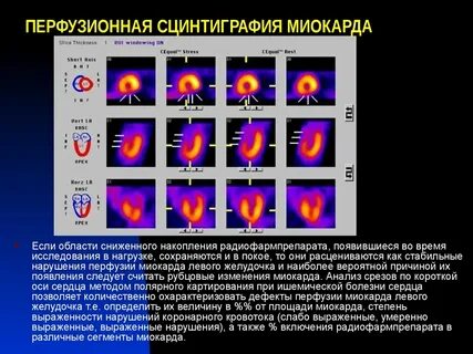 Перфузия что это