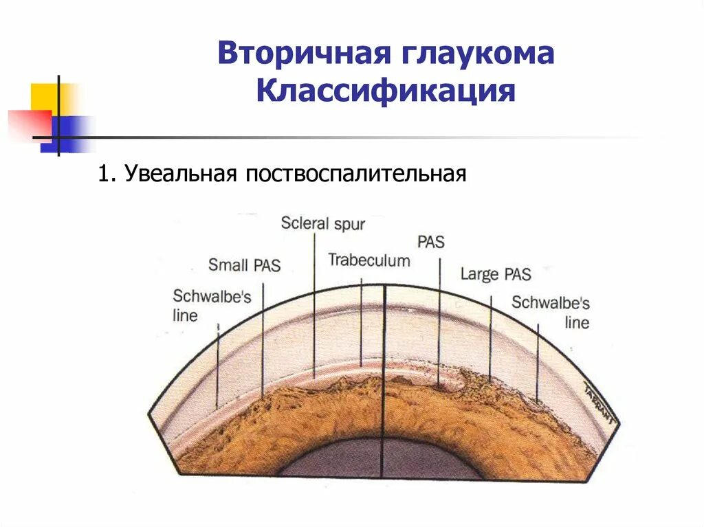 Первичная закрытоугольная глаукома классификация. Периметрическая классификация глаукомы. Классификация глаукомы