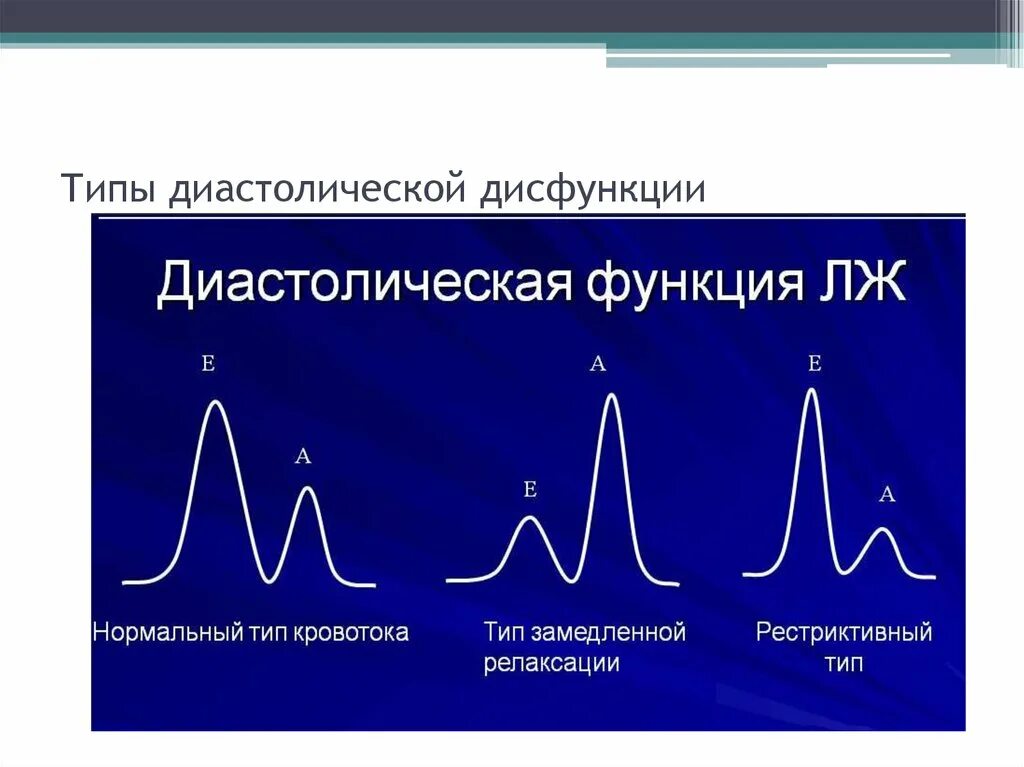 Нарушение диастолической функции левого желудочка по 1. Диастолическая дисфункция 2 типа ЭХОКГ. Типы диастолической дисфункции левого желудочка. Диастолическая дисфункция по рестриктивному типу. Типы нарушения диастолической функции левого желудочка.