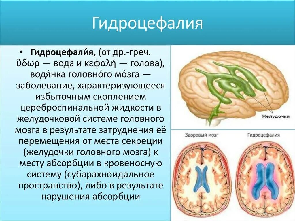 Поражение головного мозга причины. Внутренняя сообщающаяся гидроцефалия. Наружная и внутренняя гидроцефалия головного мозга. Наружная гидроцефалия головного мозга.