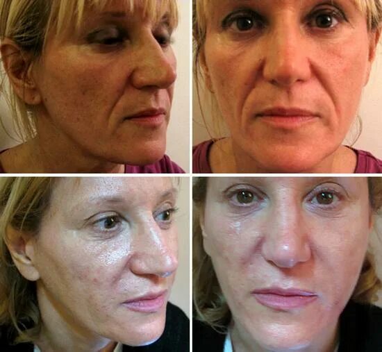 Лазерная шлифовка кожи цена skinlift ru. Фракционный лазерный термолиз. Фракционное неабляционное омоложение. Фракционный фототермолиз со2. Фракционный термолиз рубцов.