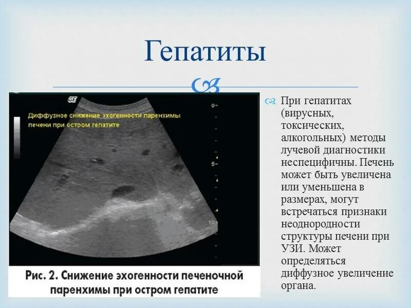 Кальцинаты селезенки. Кальцинаты в селезенке на УЗИ. УЗИ признаки хронического гепатита. Паренхима печени диффузно изменена. Кальцинаты в селезенке на кт.