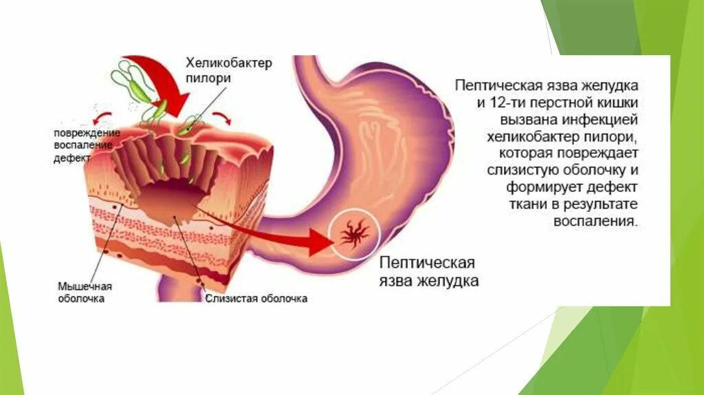 Этиология болезни 12 перстной кишки. Язва желудка и 12 перстной кишки. Язвенная болезнь луковицы двенадцатиперстной патогенез. При язве можно печень