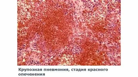 Развившегося воспаления