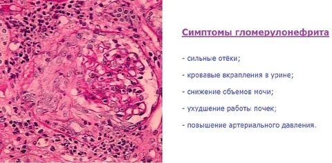 Гломерулонефрит симптомы