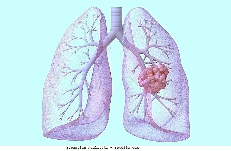 Образования в легких человека. Опухоль главного бронха.