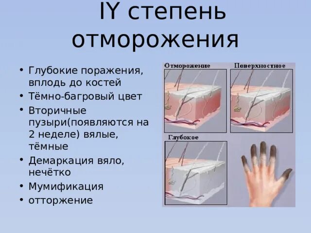 Ожоги обморожения тема. Отморожение и охлаждение. ожоги отморожения хирургия презентация.