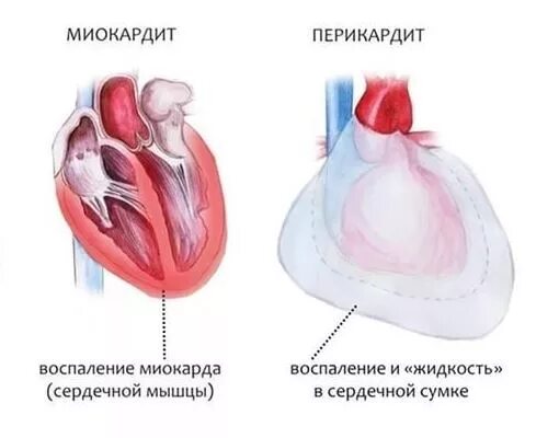 Миокардит жидкость в перикарде.