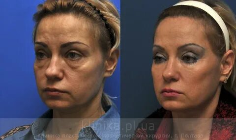 Суфы под глазами