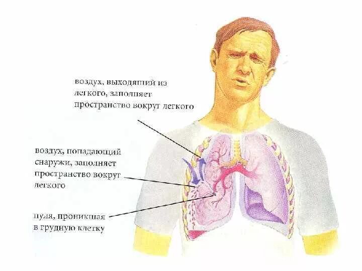 Что является признаком ранения грудной клетки. Что является признаком ранения грудной клетки