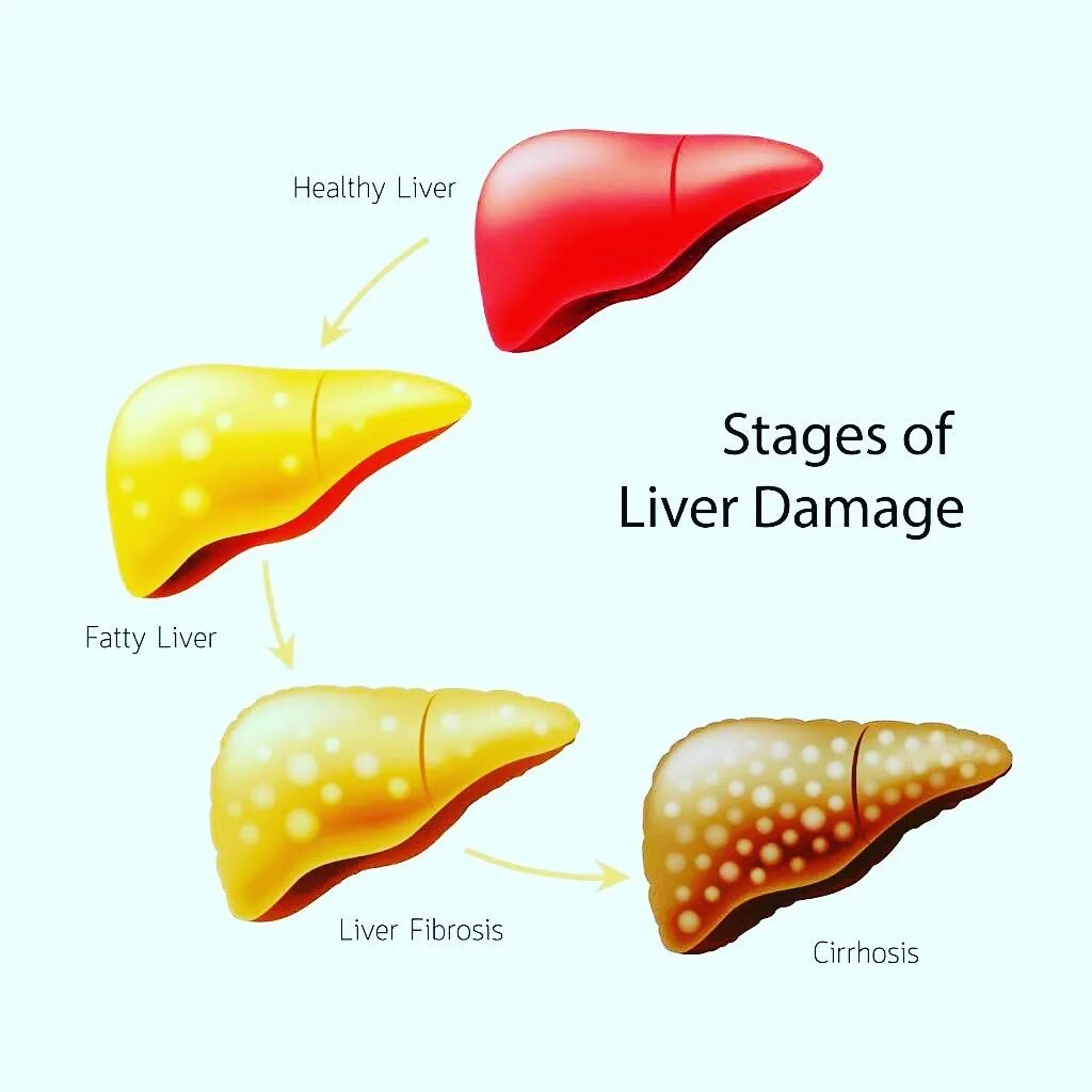 Жировая печень что это значит. Жировой гепатоз 2 степени. Жировой гепатоз 1 степени. Жировой гепатоз печени стадии. Жировое Перерождение печени.