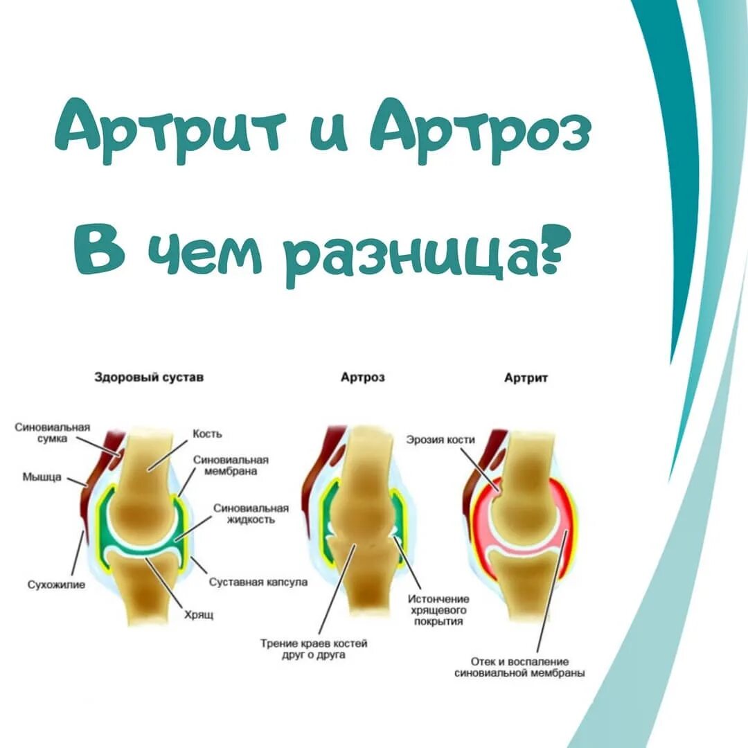 Артрит и артроз разница. Артроз или артрит в чем разница. Разница между артритом и артрозом. Артрит и артроз в чем разница чем.