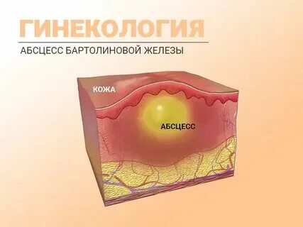 Бартолиновая железа у женщин расположение Фото бартолинова железа у женщины