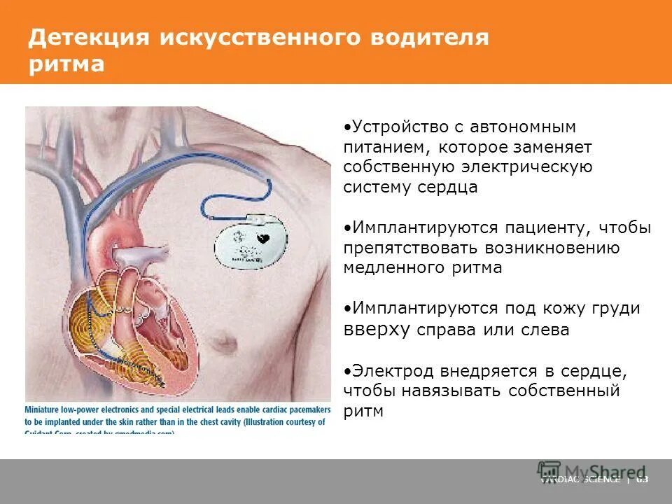 Искусственный водитель ритма. Искусственный водитель ритма