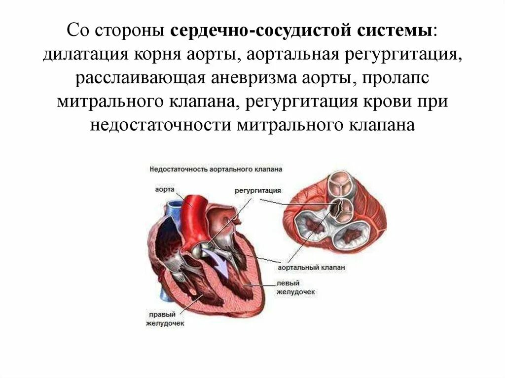 Аневризма митрального клапана у взрослого. Расслаивающая аневризма аорты аортальная недостаточность. Недостаточность клапана аорты. Сердечная недостаточность митрального клапана