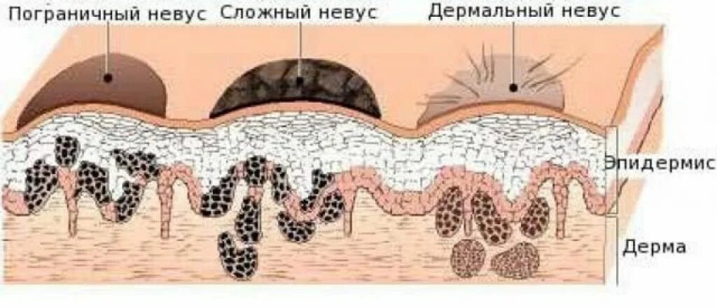 Плотный устраивать. Папилломатозный пигментный невус. Эпителиоидный невус гистология. Дермальный и эпидермальный невус. Эпидермальный бородавчатый невус.