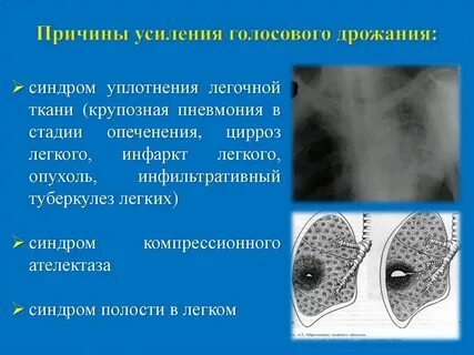 Усиление голосового дрожания