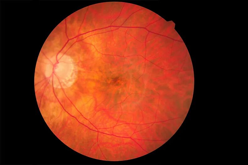 Атрофия зрительного нерва лебера. Montagen retinal platina. Буллезный ретиношизис. Montagen retinal platina. Montagen retinal platina.
