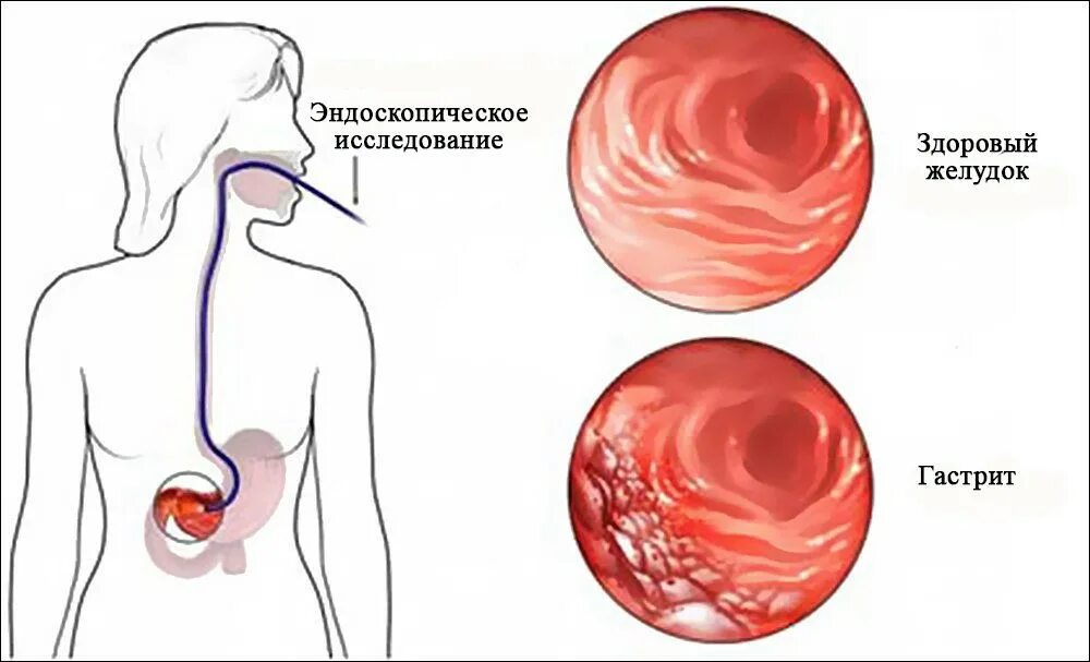 Гастрит диета. Повышенное кислотообразование в желудке. Основные методы лечения хронического гастрита. Проблемы пациента при хроническом гастрите с пониженной секрецией. Слизистая желудка при гастрите.