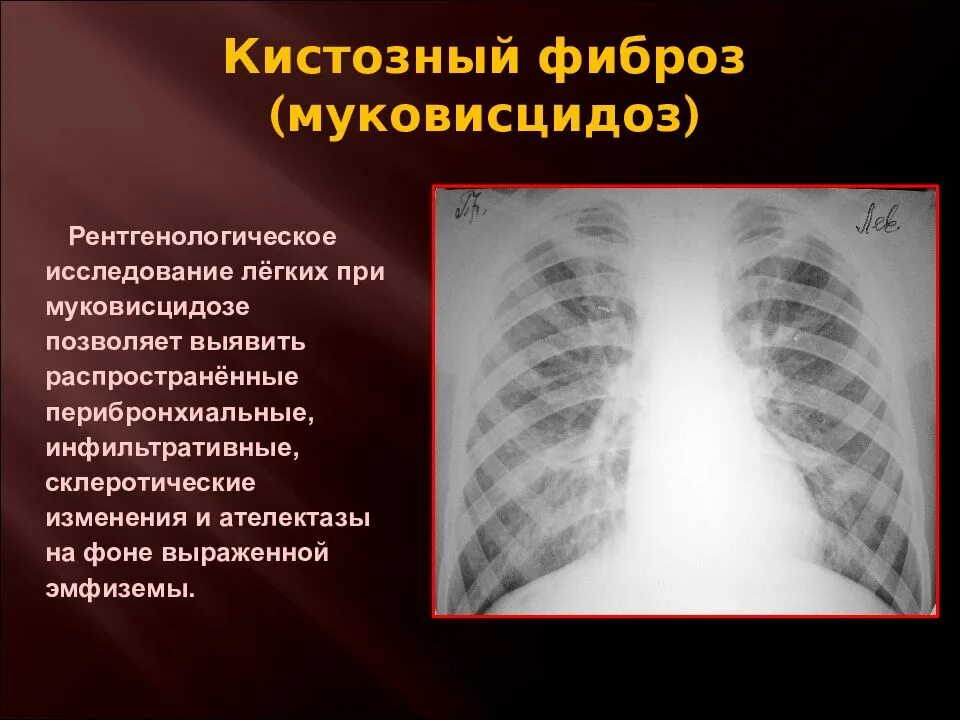 Фиброз нижних долей легких. Врожденные заболевания легких. Муковисцидоз легочная форма. Врожденные заболевания легких у детей.