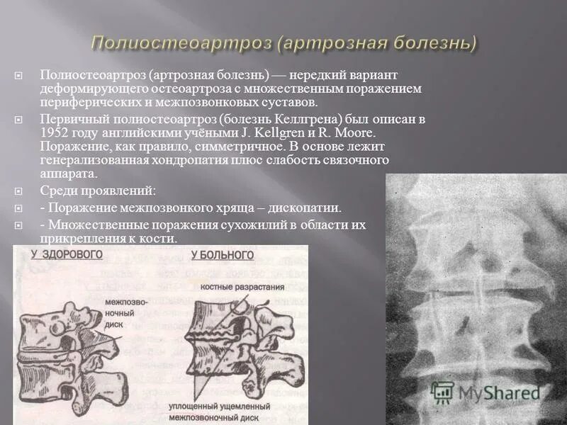 Дегенеративно дистрофические поражения