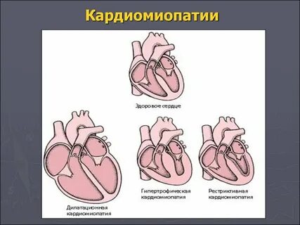 Классификация кардиомиопатий
