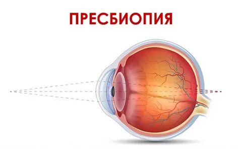 Слабая пресбиопия