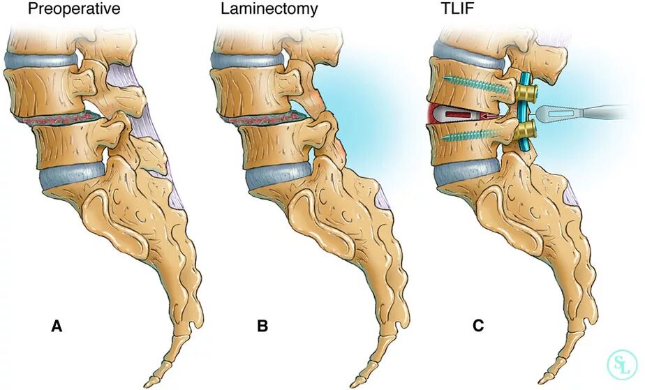 Операция антелистез l5. L3 l4 позвонки. Спондилолистез l5 операция. L4 l5 смещение позвонка. Пояснично крестцовый отдел операция на позвоночнике