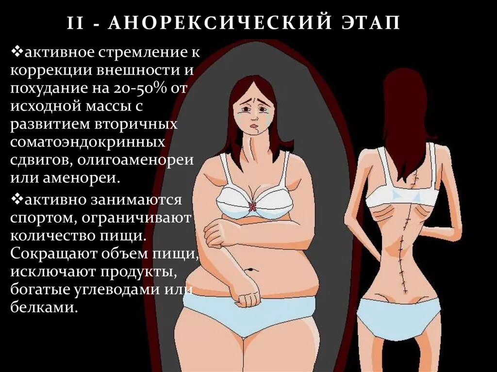 Анорексия стадии. Этапы развития нервной анорексии. ожирение анорексия и булимия.