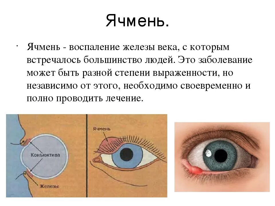 Этапы развития ячменя на глазу. Как выглядит ячмень на глазу. Почему вылазит глаз