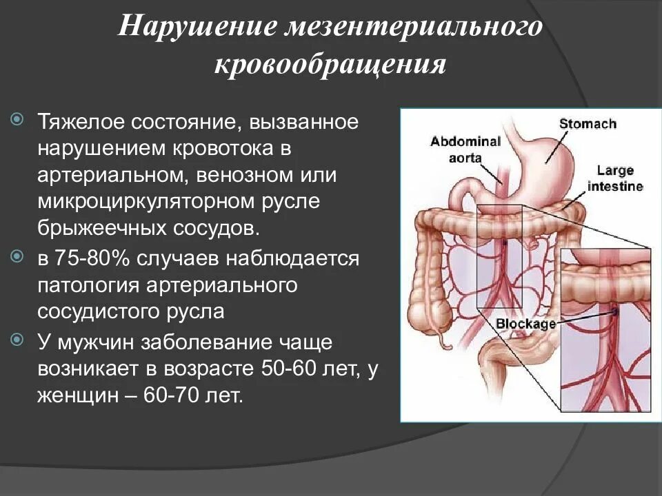 Мезентериальные сосуды атеросклероз. Мезентериальный тромбоз этиология. Синдром недостаточности верхней брыжеечной артерии. Нарушение кровообращения брыжеечных сосудов. Острое мезентериальное кровообращение