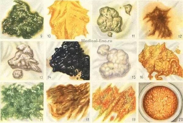 какого цвета кал при панкреатите. кал при недостаточности поджелудочной железы. кал при хроническом панкреатите. характер стула при хроническом панкреатите тесты. поджелудочная железа человека.