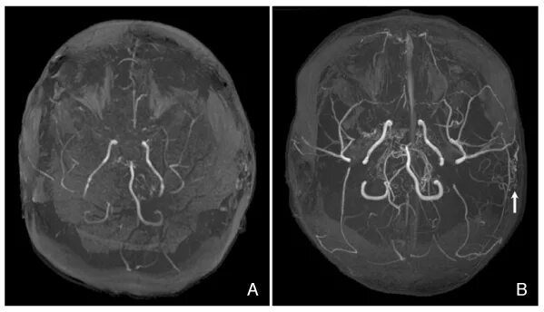 Венография головного мозга. Кт-венография тромбоз сосудов головы. Мрт сосудов мозга. Мрт сосудов головы.