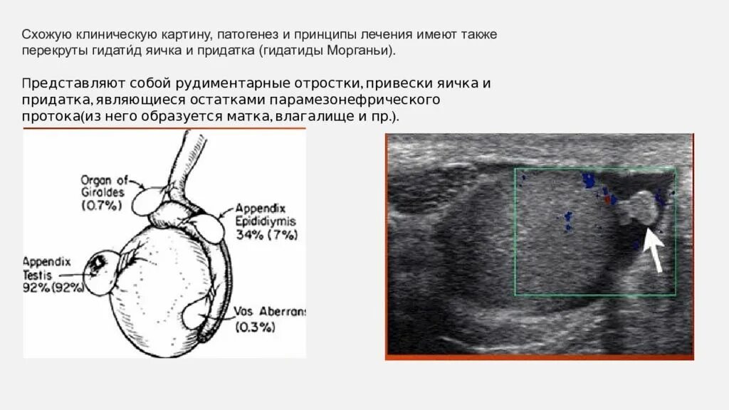 Тянущая боль у мужчины правого яичка. Перекрут гидатиды яичка УЗИ протокол. Перекрут яичка УЗИ протокол. Перекрут гидатиды придатка яичка. Перекрут гидатиды яичника.