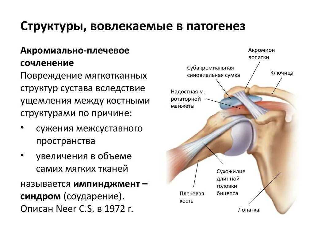 Лопаточно-плечевой периартрит. Периартрит плечевого сустава синдром. Суставы лопаточно плечевой воспаление. Плечелопаточный периартрит симптомы.