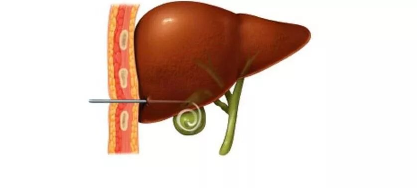 Печень после операции. Дренирование желчного пузыря. Катетер в желчном пузыре. Трубка из желчного пузыря для оттока желчи.