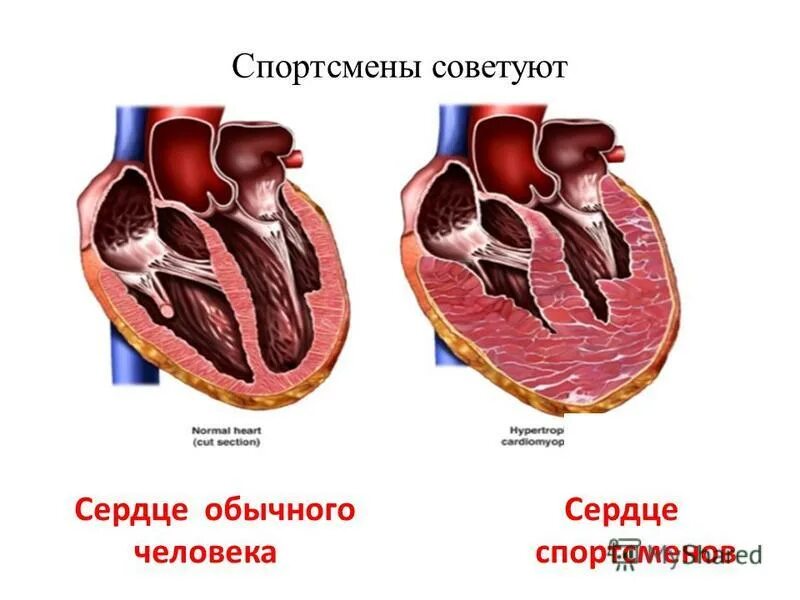 Спортивное сердце гипертрофия миокарда. Сердце спортсмена и обычного человека. Сердце тренированного и нетренированного человека.