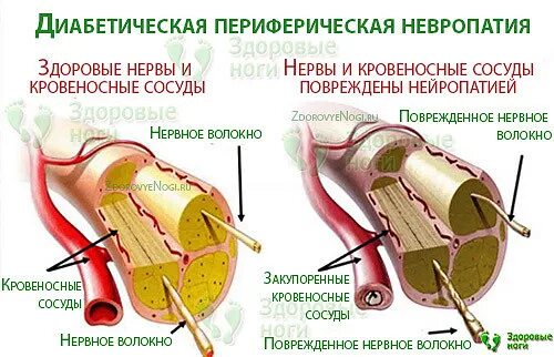 Диабет невропатия. Диабетическая невропатия. Диабетическая периферическая нейропатия. Нейропатическая форма диабетической стопы. Нейропатическая диабетическая стопа.