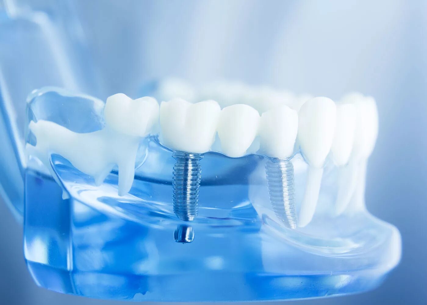 Dental implantation. Красивые зубы. Креативная реклама стоматологии. Osstem импланты производитель. Dental implantation.