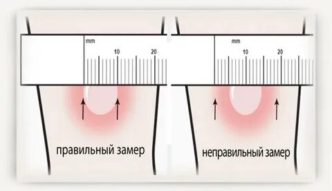 Манту 10 мм у ребенка