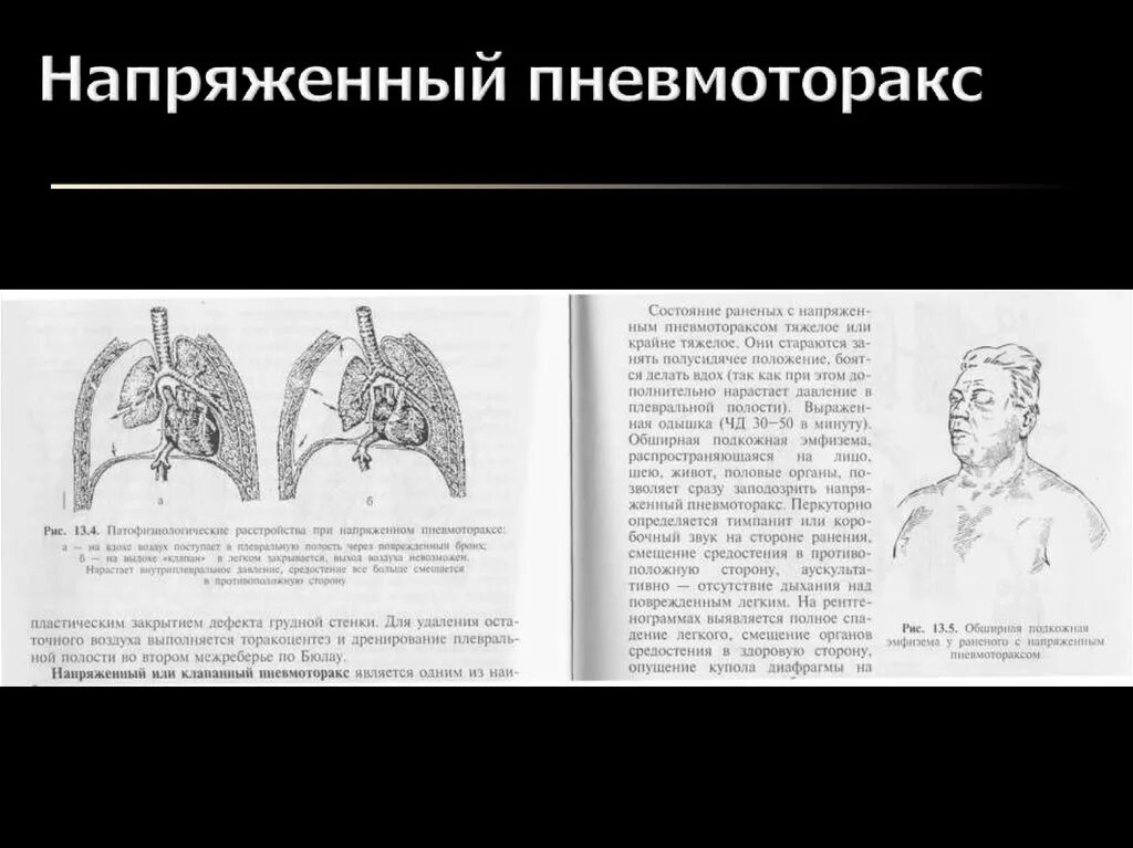 Напряженный пневмоторакс помощь. Подкожная эмфизема аускультация. Напряженный пневмоторакс подкожная эмфизема. Подкожная эмфизема рентген.